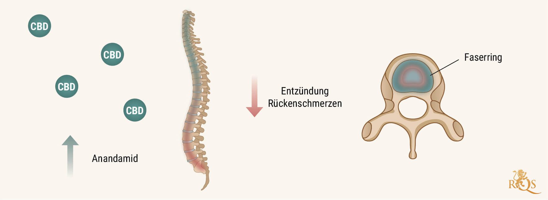 Wie hilft CBD bei degenerativer Bandscheibenveränderung?