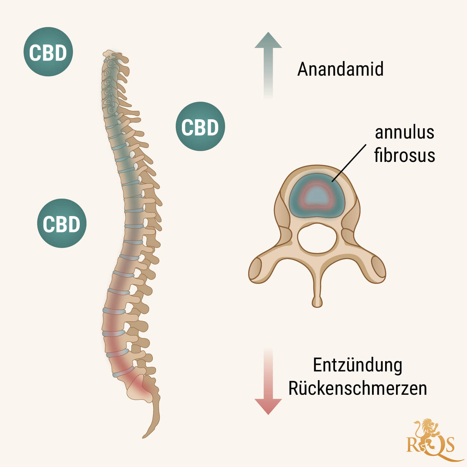 Wie hilft CBD bei degenerativer Bandscheibenveränderung?